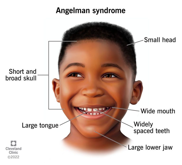 Homeschooling Anak dengan Sindrom Angelman: Pendekatan yang Tepat untuk Pembelajaran di Rumah